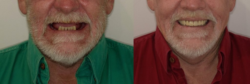 All-on-X Before & After