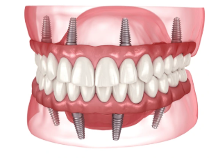 All-on-X dental implants supporting a full arch of replacement teeth